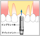 インプラント構造1