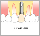 インプラント構造3