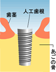 インプラントの治療の流れ