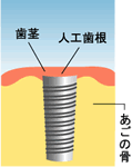 インプラントの治療の流れ