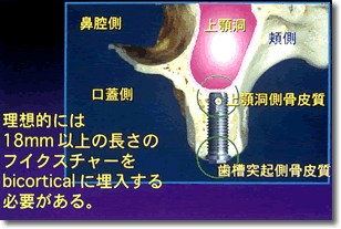 サイナスグラフト
